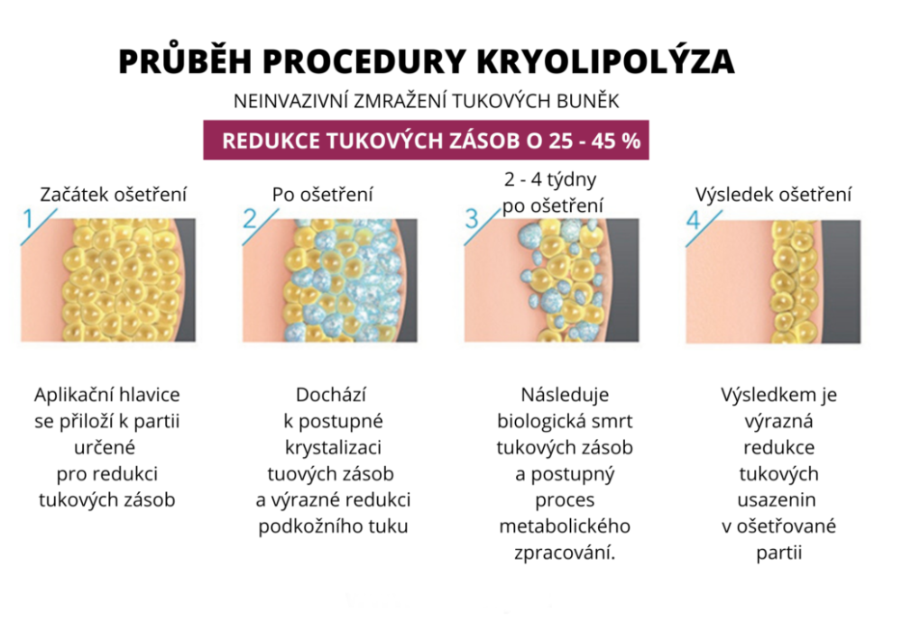 Kryolipolýza