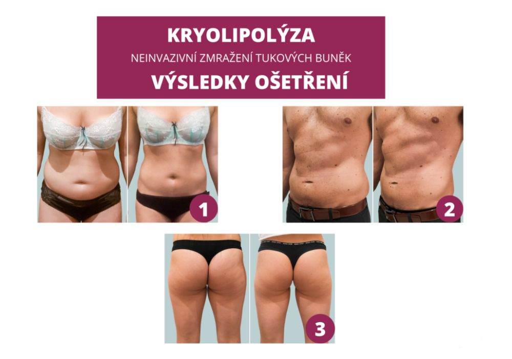 Kryolipolýza