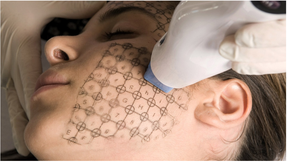 Thermage ultra Thermage ultra